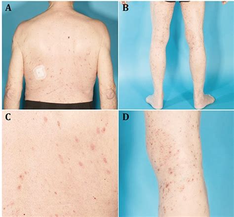 Ibrutinib Associated Skin Toxicity A Case Of Maculopapular Rash In A