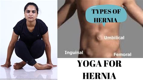 can i do yoga with an umbilical hernia