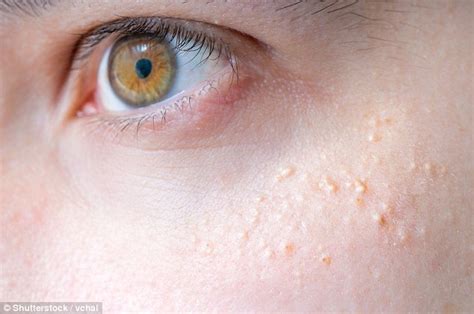 The Pimples The Experts Say You Should Never Pop And How They Should