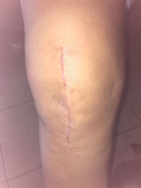 During a knee replacement, an incision is inevitable. This scar from the total knee replacement is about 50% ...