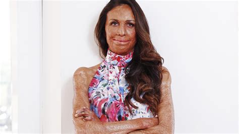 Burns Survivor Turia Pitt Condemns Australias Treatment Of Women The Australian