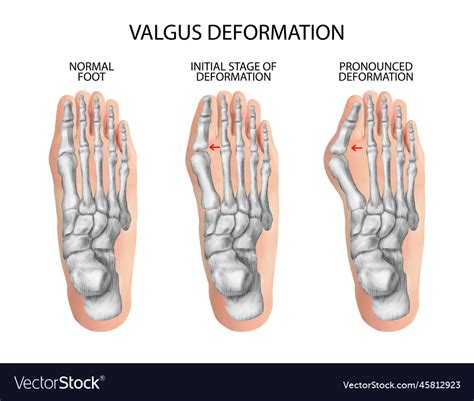 Valgus Deformity Of The Toes Royalty Free Vector Image