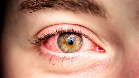 25 Things You Need To Know About Eye Strain Symptoms And How To Combat Them Vibraxlabs