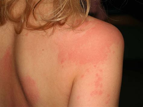 Different Types Of Itchy Skin Rashes