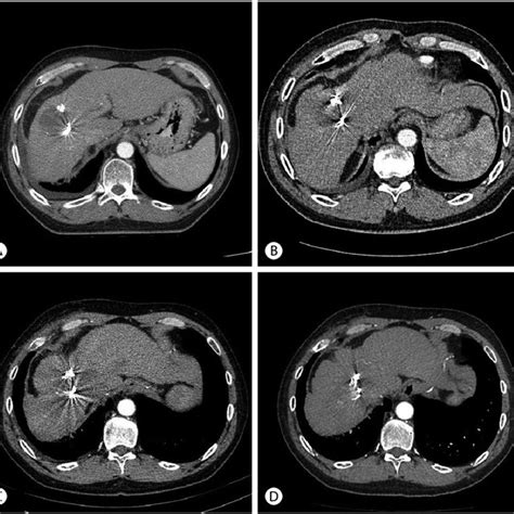 Findings On Follow Up Dynamic Computed Tomography Scan After