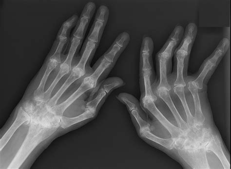 Rheumatoid Arthritis Of The Hand Hands