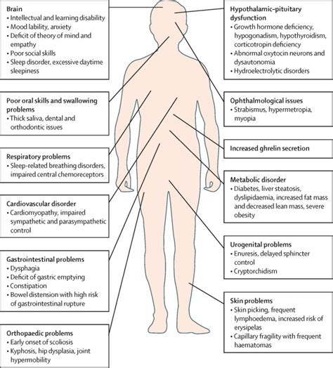Endocrine Disorders In Prader Willi Syndrome A Model To Understand And
