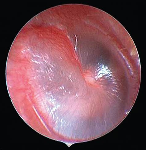 The Spoke Sign An Otoscopic Diagnostic Aid For Detecting Otitis