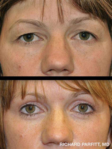 Eyelid Surgery Before And After Photos
