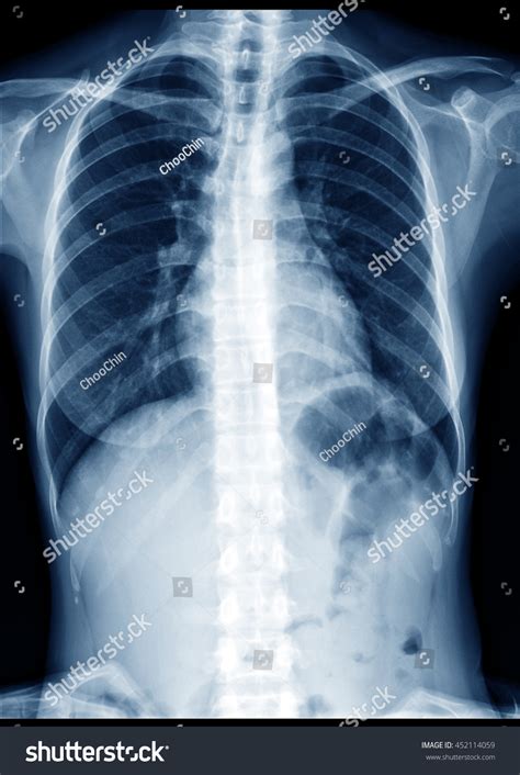 Chest Xray Normal Healthy Woman Show Stock Photo Edit Now