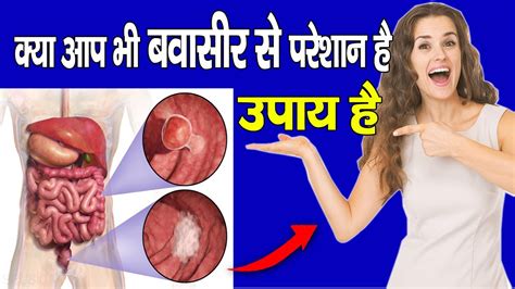 बवासीर How To Cure Piles How To Cure Piles At Home Hemorrhoids