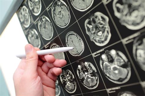 The recovery of this condition depends on the placement of the tumor, the health of the cat and whether it is benign or malignant. If a Brain Tumor is Not Cancerous, Why Do Anything About ...