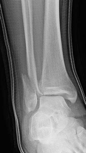 Hairline Fracture Ankle