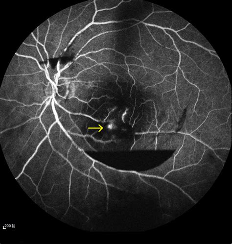 A Retinal Arterial Macroaneurysm With Telangiectatic Retinal Vascular