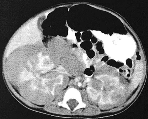 Wilms Tumor In The Setting Of Bilateral Nephroblastomatosis Radiographics