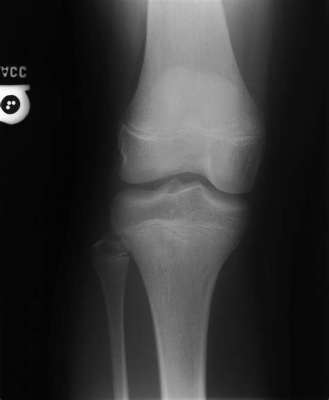 Osgood Schlatter Disease And Non Ossifying Fibroma Image
