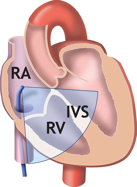 Home View Showing The Right Heart Including The Interventricular