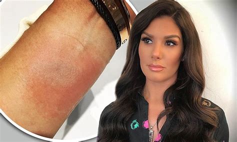 I'm not being funny but i don't need the money, what would i gain from selling stories on. Rebekah Vardy reveals nasty red burn from curling iron ...