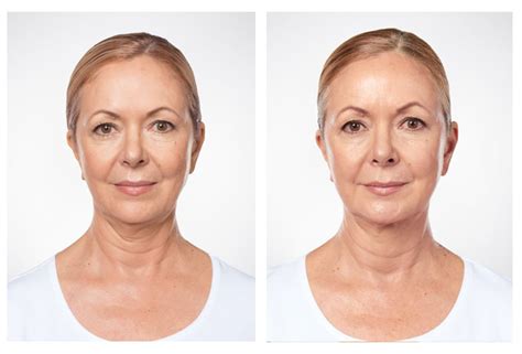 Kybella® Injections Treat Double Chin Pioneer Valley Plastic Surgery