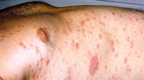 Causes Of A Red Circle On The Skin Other Than Ringworm