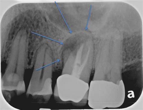 X Ray Of Painful Infected Molar Tooth Mint Hill Dentistry Dentist
