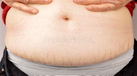 Stretch Marks Skin Stock Images Download 1126 Royalty Free Photos