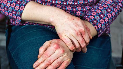 Eczema Atopic Dermatitis Symptoms Treatment Causes More