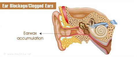 Clogged Ears Causes Picture Symptoms And Treatment