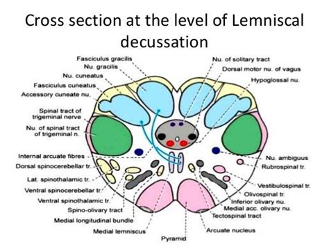 Neurological lesion identification motor (corticospinal pathway) localises the lesion to the contralateral medial brainstem. Cross section at Level of inferior olivary nuclei