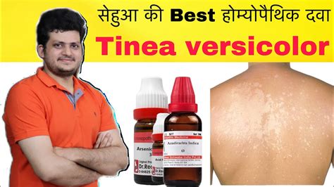 सेहुआ की Best Homeopathic Medicine Tinea Versicolor Remove