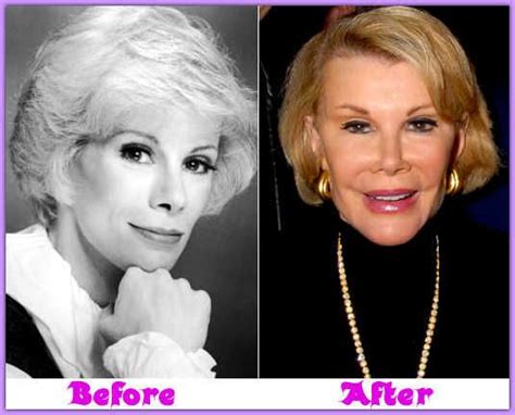 Joan Rivers Plastic Surgery Before And After Joan Rivers Plastic