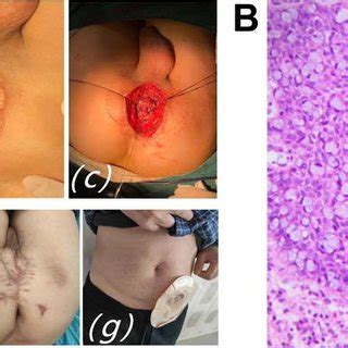 A Case 3 A And B Skin Induration Around The Anus And Scout Line