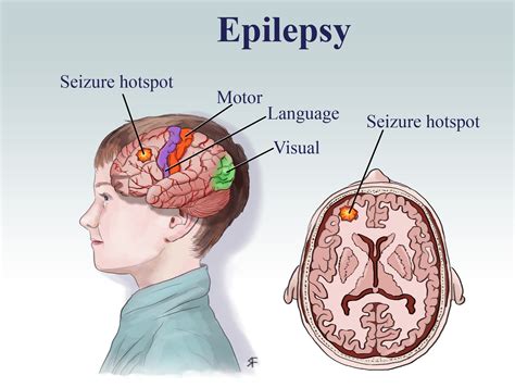 epilepsy what are seizures and epilepsy epilepsy is a medical condition where a person has