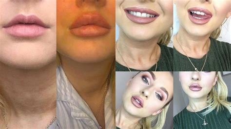 Lip Injection Experience Before And After Youtube