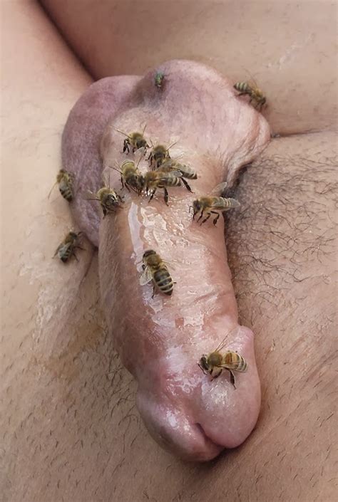 Severe Bug Bites