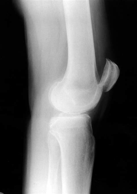 Superior Dislocation Of The Patella A Case Report And Review Of The