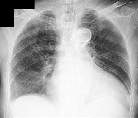 Figure1a Chest Radiograph On Admission Showed Bilateral Infiltrates