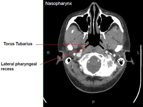 Nasopharynx Anatomy Radiology Anatomy Structure