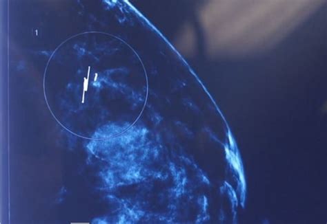 New Tech Improves Breast Lumpectomy For Patients And Doctors Mercy