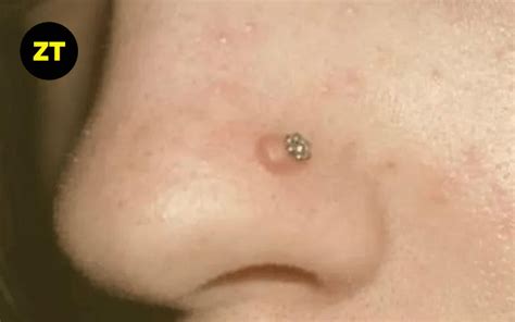 Hypertrophic Scar On Nose Piercing Guide Zero Tough