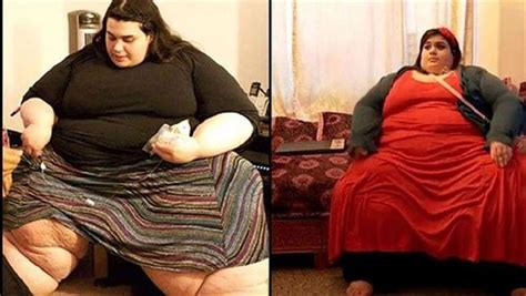 Super Obese Amber Loses An Astonishing 200kg