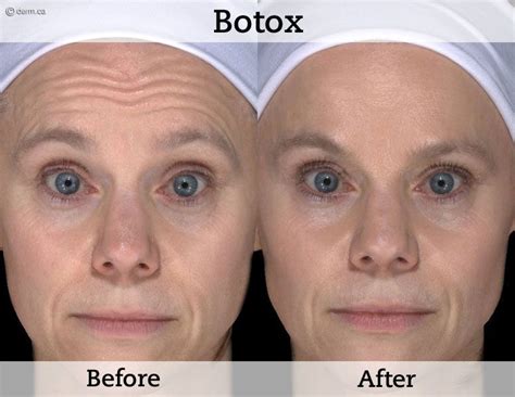 Botox Injections Austin Tx Botox Cosmetic Andrew Trussler Md
