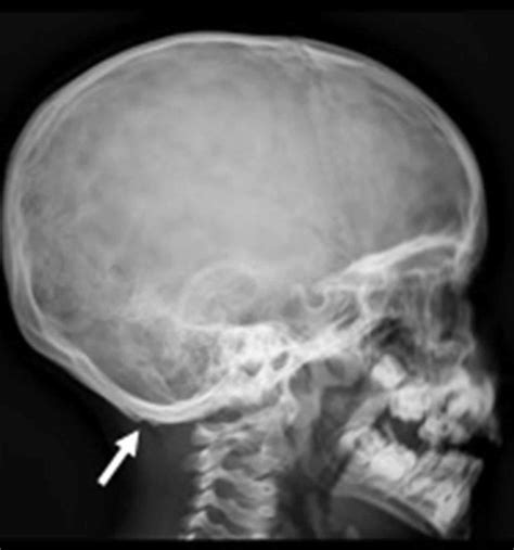 Occipital Horn Syndrome Causes Symptoms Diagnosis Treatment And Prognosis