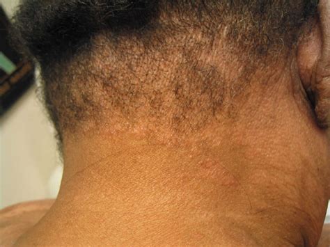 Follicular Mucinosis Causes Symptoms Diagnosis And Treatment
