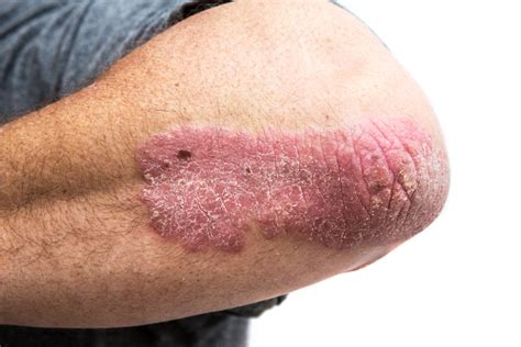 Psoriasis And Cancer Whats The Link Harvard Health