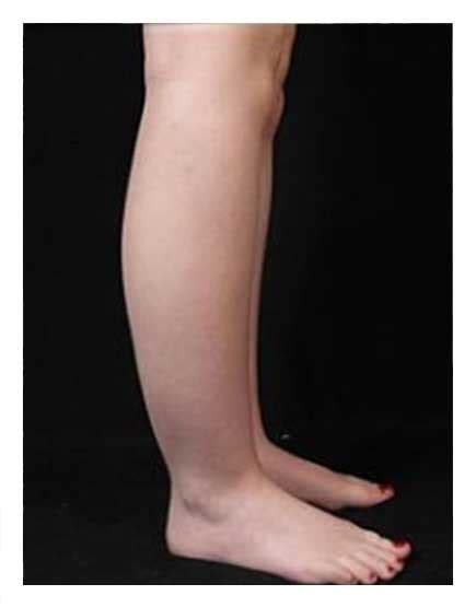 Cankle Treatments London Get Causes Solutions Costs And Before And Afters