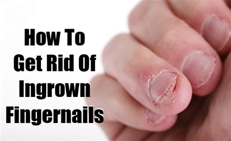 If this happens, try applying a topical steroid treatment to soothe the inflammation. How To Get Rid Of Ingrown Fingernails | Find Home Remedy ...
