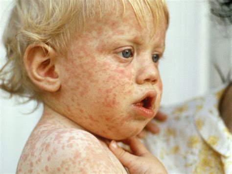 Measles Babycenter
