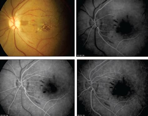 Scielo Brasil Central Retinal Artery Occlusion Associated With