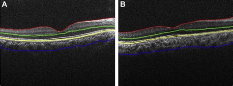 A Prospective Oct Study Of Rubella Retinopathy Ophthalmology Retina